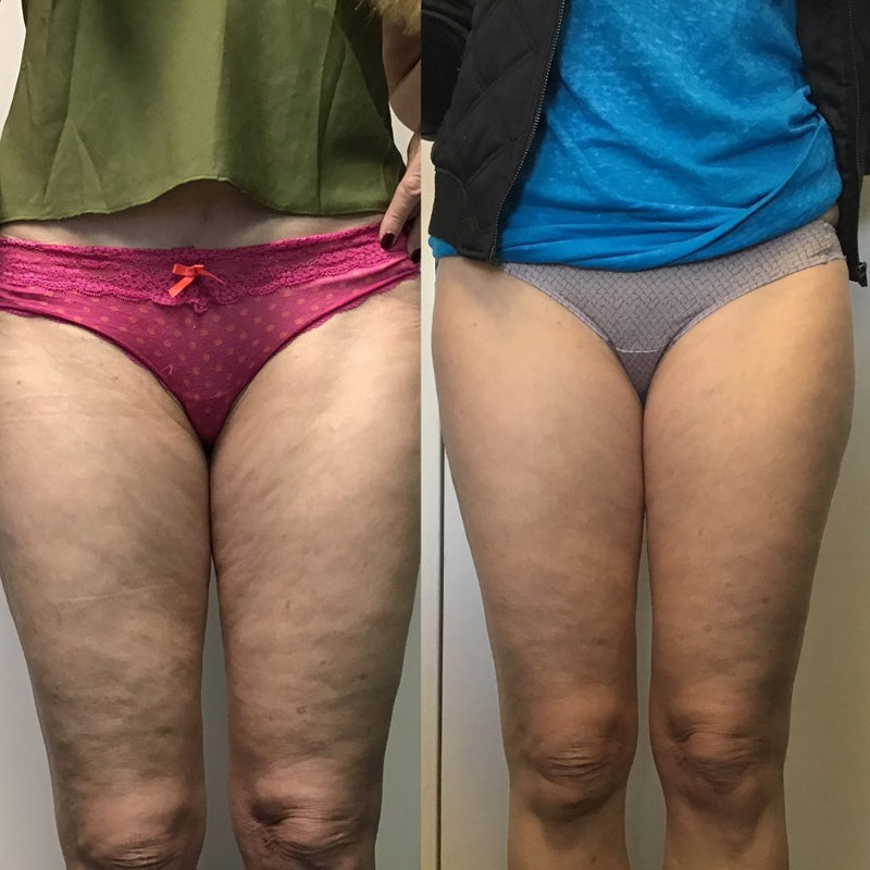Does the 3D anti-cellulite legging really work? Reviews and testimonials