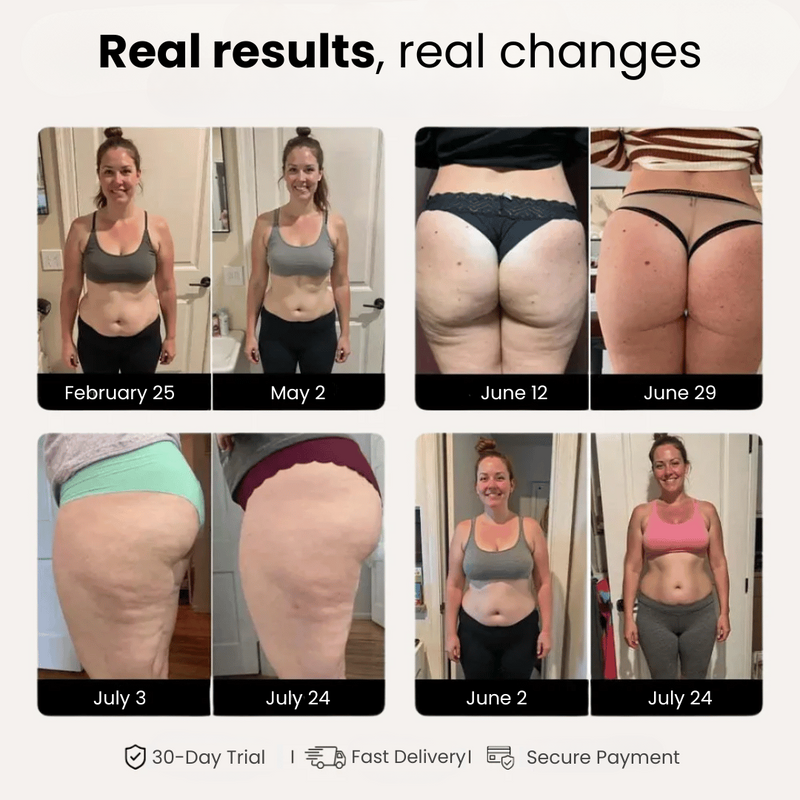 The science behind anti-cellulite 3D leggings: myth or reality?